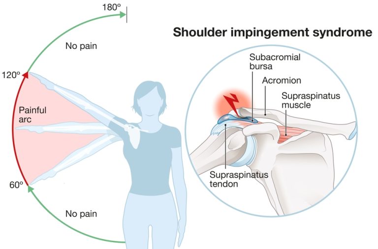 What Is The Best Exercise For Shoulder Impingement Anxiety Fighters