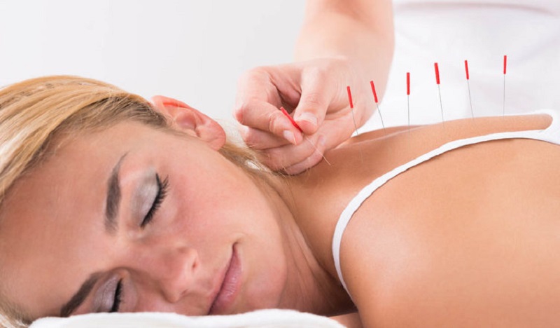 Acupuncture Therapy