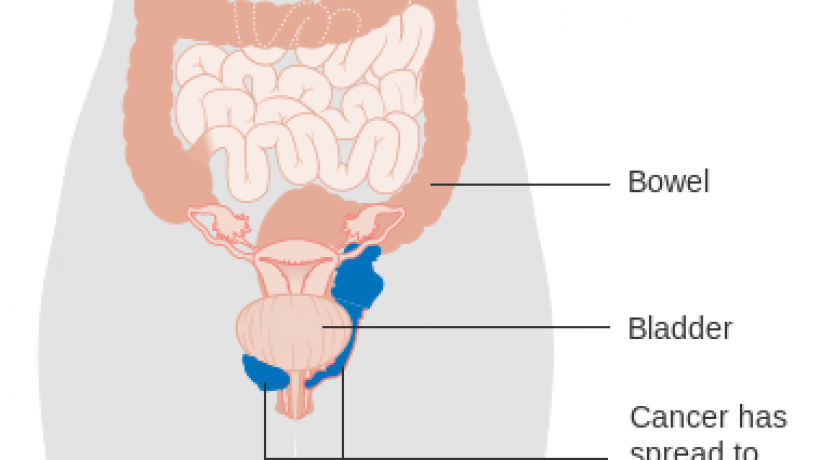 Is it vaginal cancer? Signs to look out for