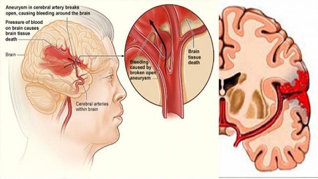 How To Prevent Brain Stroke – Anxiety Fighters Guide