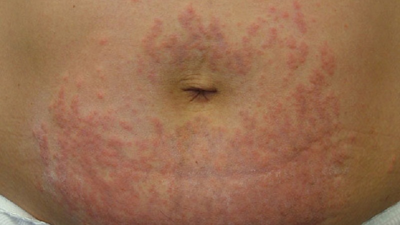 skin-rash-on-stomach