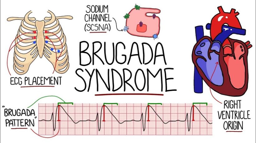 Brugada syndrome: causes, symptoms, risks, treatment