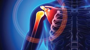What is the Best Exercise for Shoulder Impingement?